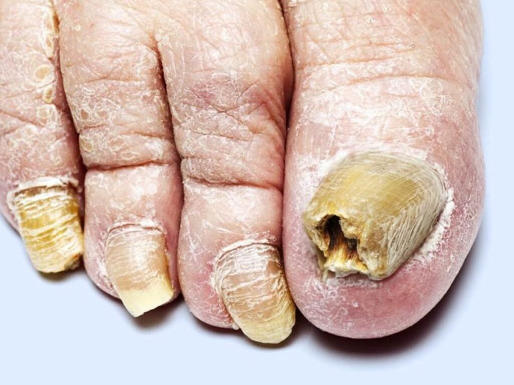como curar el hongo en los pies